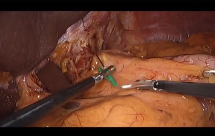 Aplicaciones del Verde de Indocianina en la cirugía del cáncer de esófago.