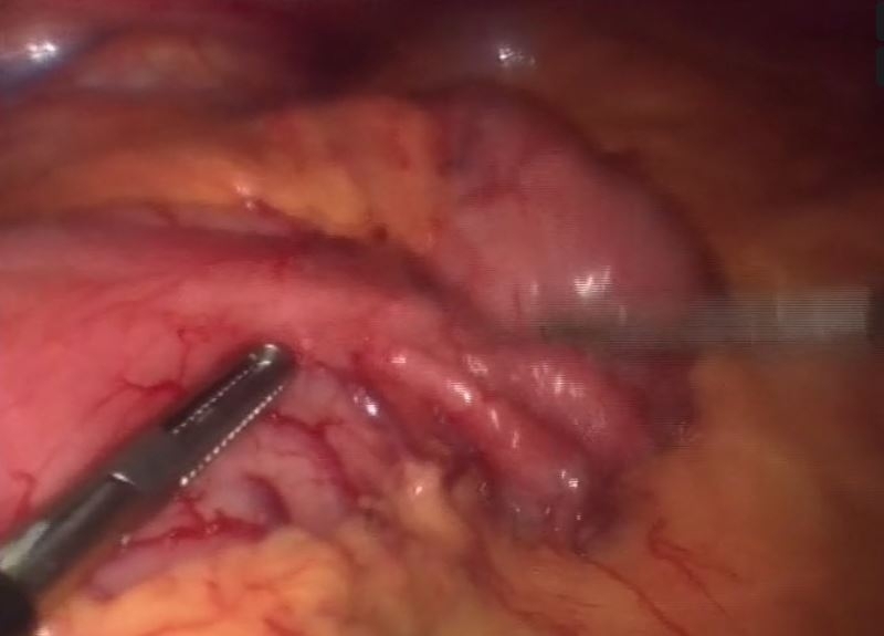Resección transgástrica de tumor estromal por laparoscopia