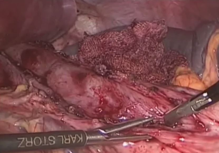 Tratamiento de la acalasia mediante miotomía Heller laparoscópica