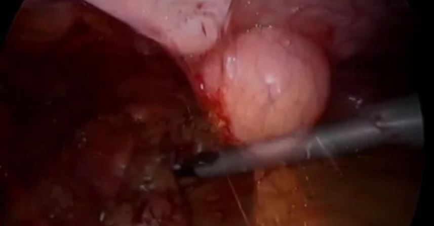 Esofagocoloplastia retroesternal video asistida tras esófago-gastrectomía por perforación esofágica