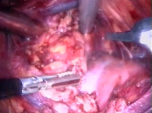 Adrenalectomía izquierda por vía laparoscópica transabdominal anterior;  técnica personal