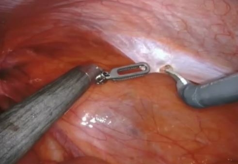 Hernioplastia inguinal minimamente invasiva (TAPP) asistida por robot Da Vinci