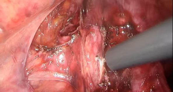 Resección completa de divertículo esofágico medio mediante abordaje toracoscópico derecho