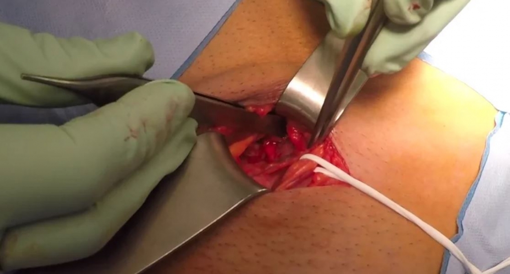 Vía preperitoneal abierta en la reparación de hernia inguinal: técnica de Nyhus modificada.