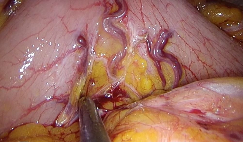Pancreatectomía corporo-caudal laparoscópica con preservación del bazo y de los vasos esplénicos (técnica de kimura) por insulinoma de cuerpo pancreático.