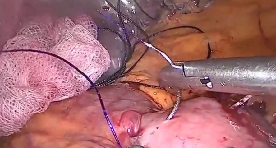 Cirugía de revisión de gastrectomía vertical a bypass gástrico por RGE refractario con resección de estómago torsionado y anastomosis gastroyeyunal fallida corregida.