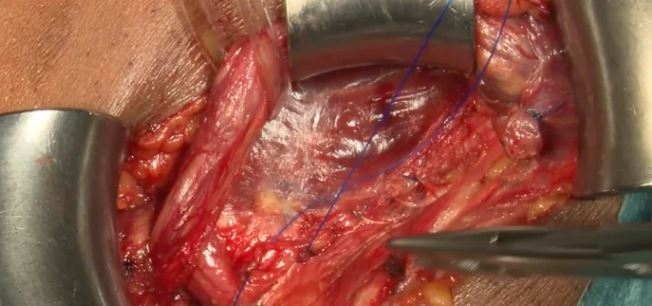 Herniorrafia inguinal anterior de Shouldice
