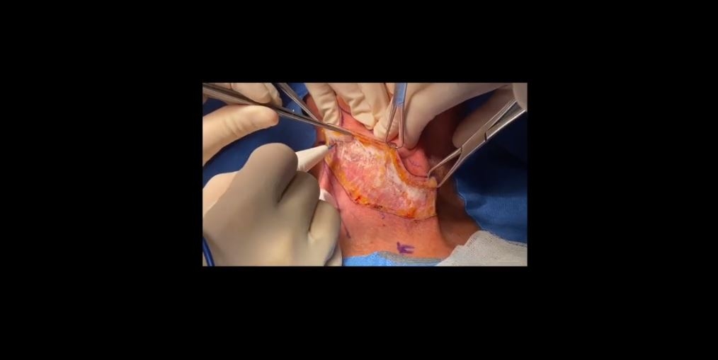Linfadenectomía cervical lateral derecha. Técnica de lateral a medial