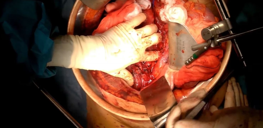 Leiomiosarcoma de vena cava: utilización de la reconstrucción 3D para la planificación quirúrgica.