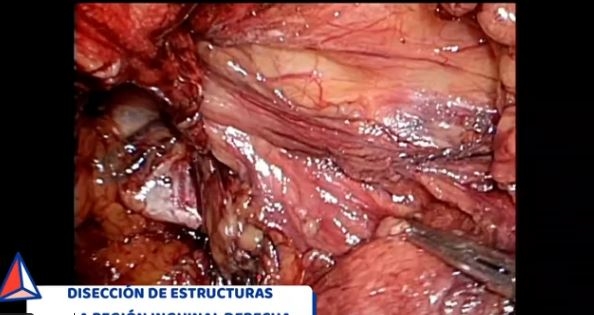 Tratamiento simultáneo de hernias incisionales ventrales, hernia inguinal y diastasis mediante abordaje laparoscópico extraperitoneal: eTEP+TAR.