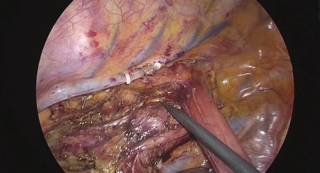 Anastomosis circular grapada con bolsa de tabaco en la esofagectomía Ivor-Lewis.