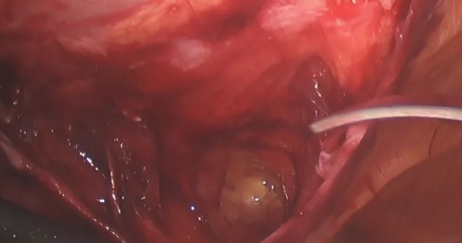 Abordaje trans abdomino preperitoneal (TAPP) laparoscópico para la reparación de la hernia de Spiegel