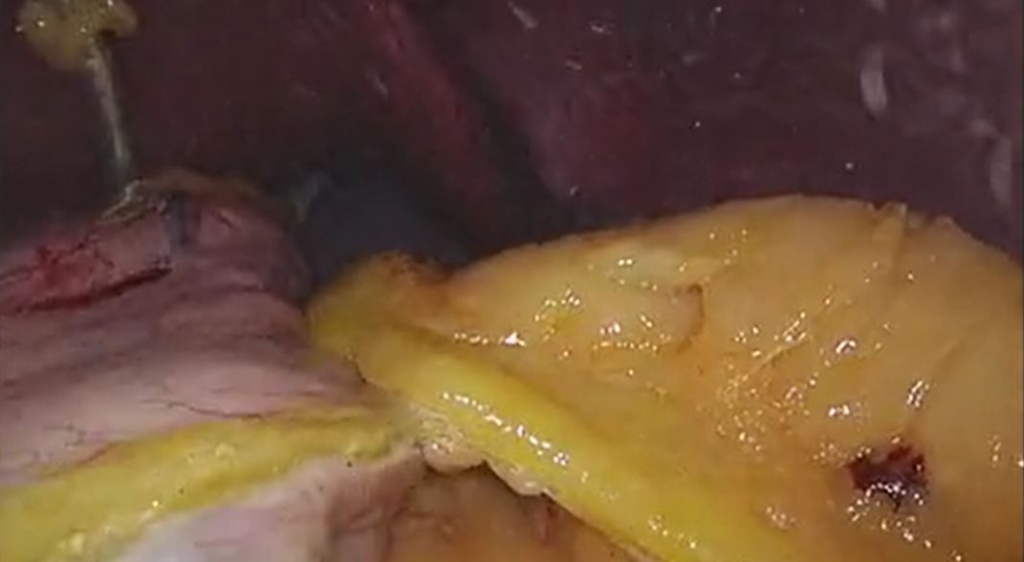 Gastrectomía Vertical Laparoscópica 