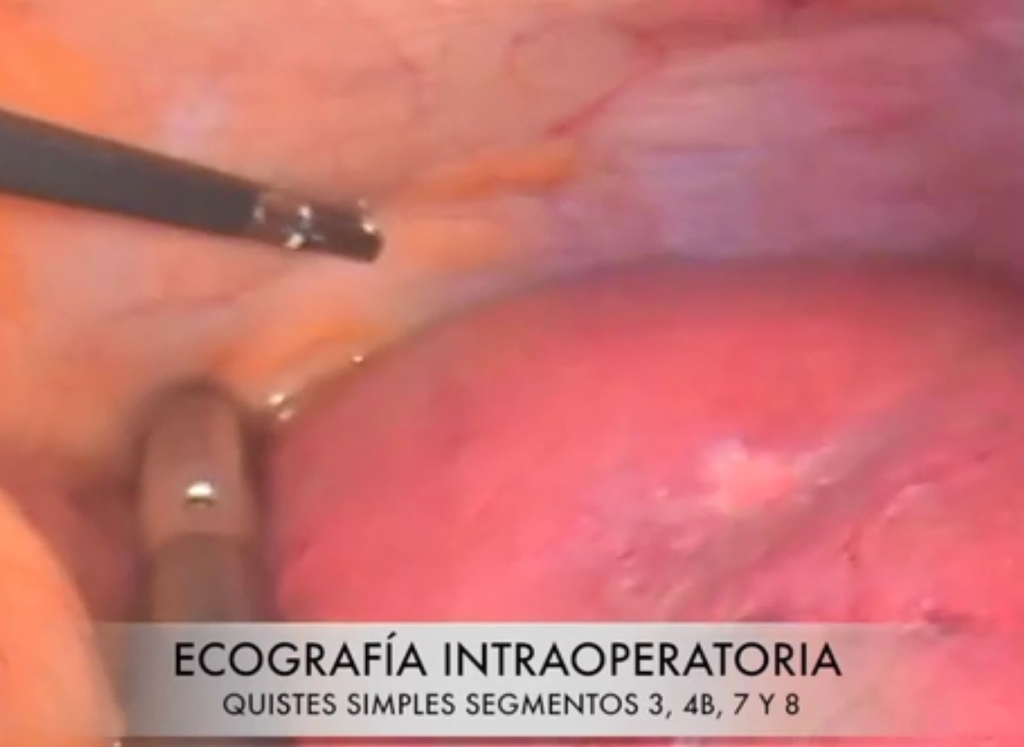 Control Ecoguiado por Doppler de arteria selectiva en segmentectomía 5 totalmente laparoscópica