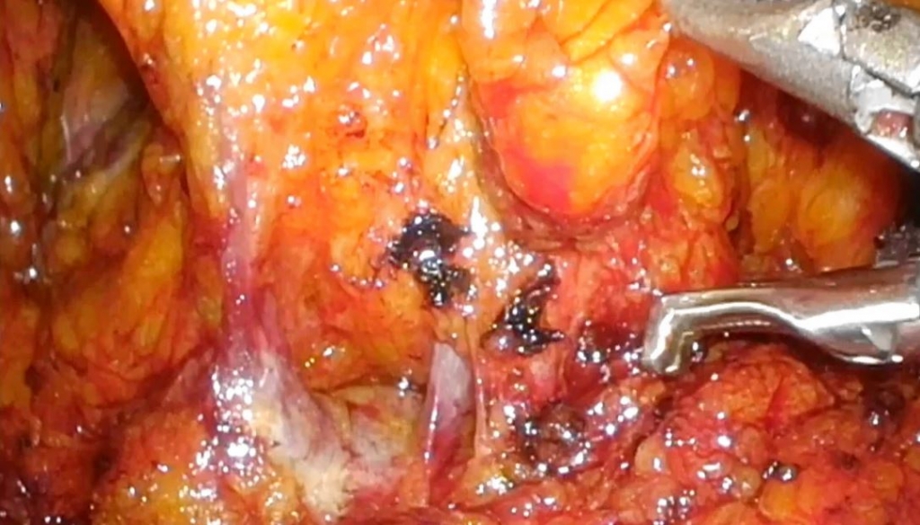 Procedimiento laparoscópico de Deloyers para anastomosis sin tensión en la colectomía izquierda extendida