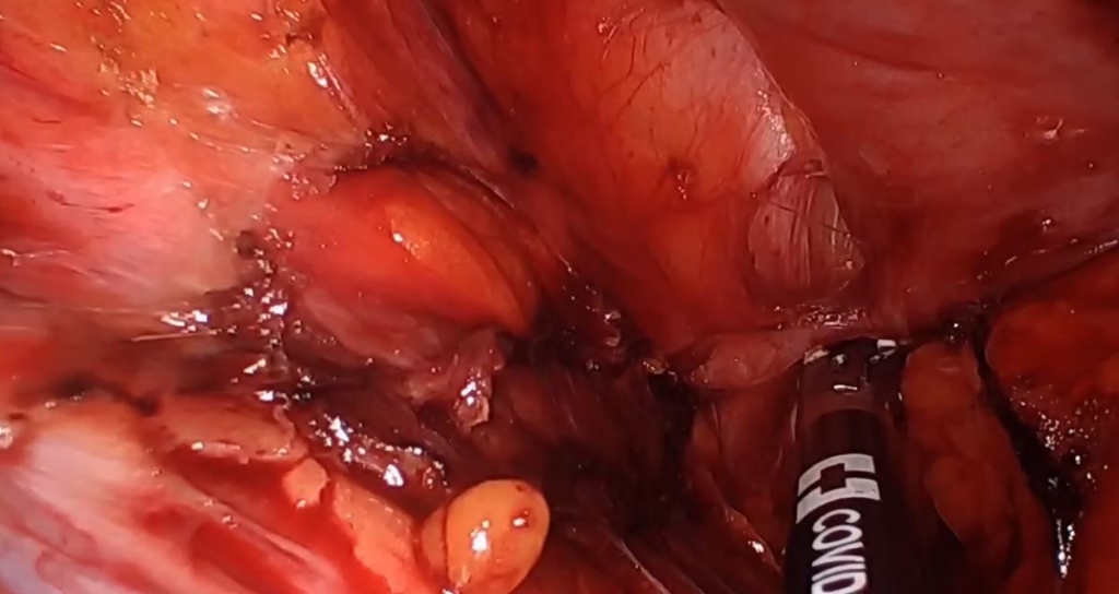 Absceso del músculo ileo-psoas derecho recurrente secundario a fístula del muñón apendicular: manejo mediante abordaje laparoscópico